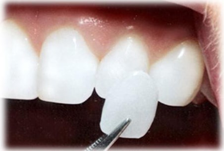 Выравнивание зубов - винирами