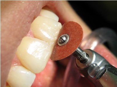 Выравнивание зубов - реставрация
