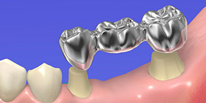 Зубной протез - мостовидный