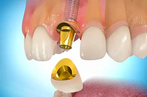 Импланты для протезировния зубов
